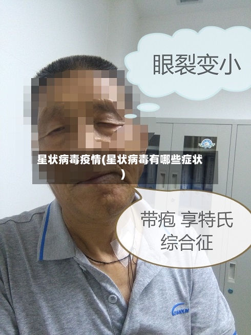 星状病毒疫情(星状病毒有哪些症状)-第2张图片